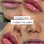 تزریق و ساکشن چربی درمطب