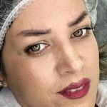 فیبروز میکرو شیدینگ لب خط چشم ریموو تک جلسه