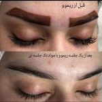 فیبروز میکرو شیدینگ لب خط چشم ریموو تک جلسه